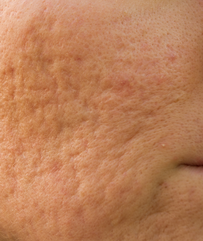 Close-up image of acne scarring